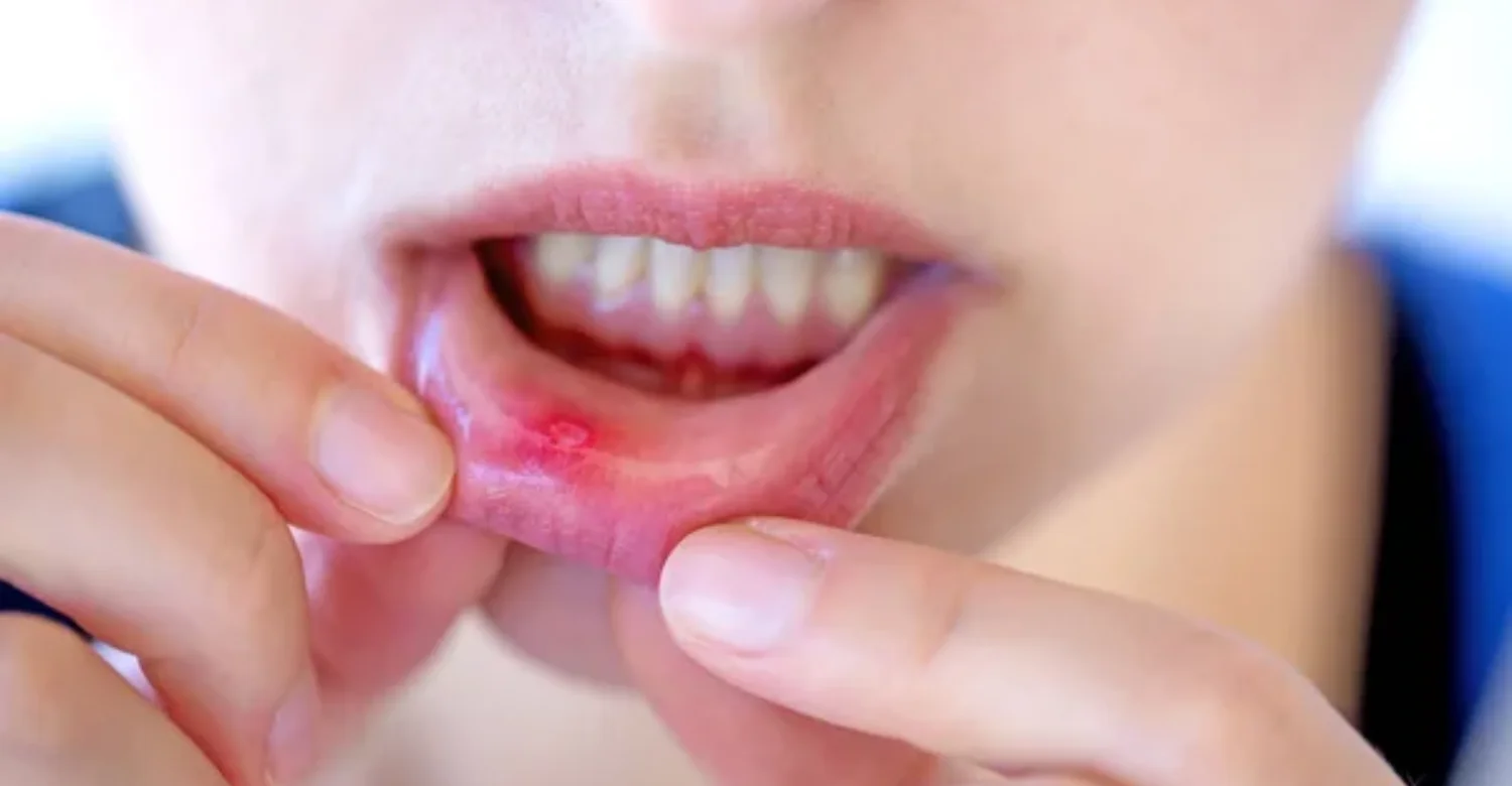 oral stomatitis 1